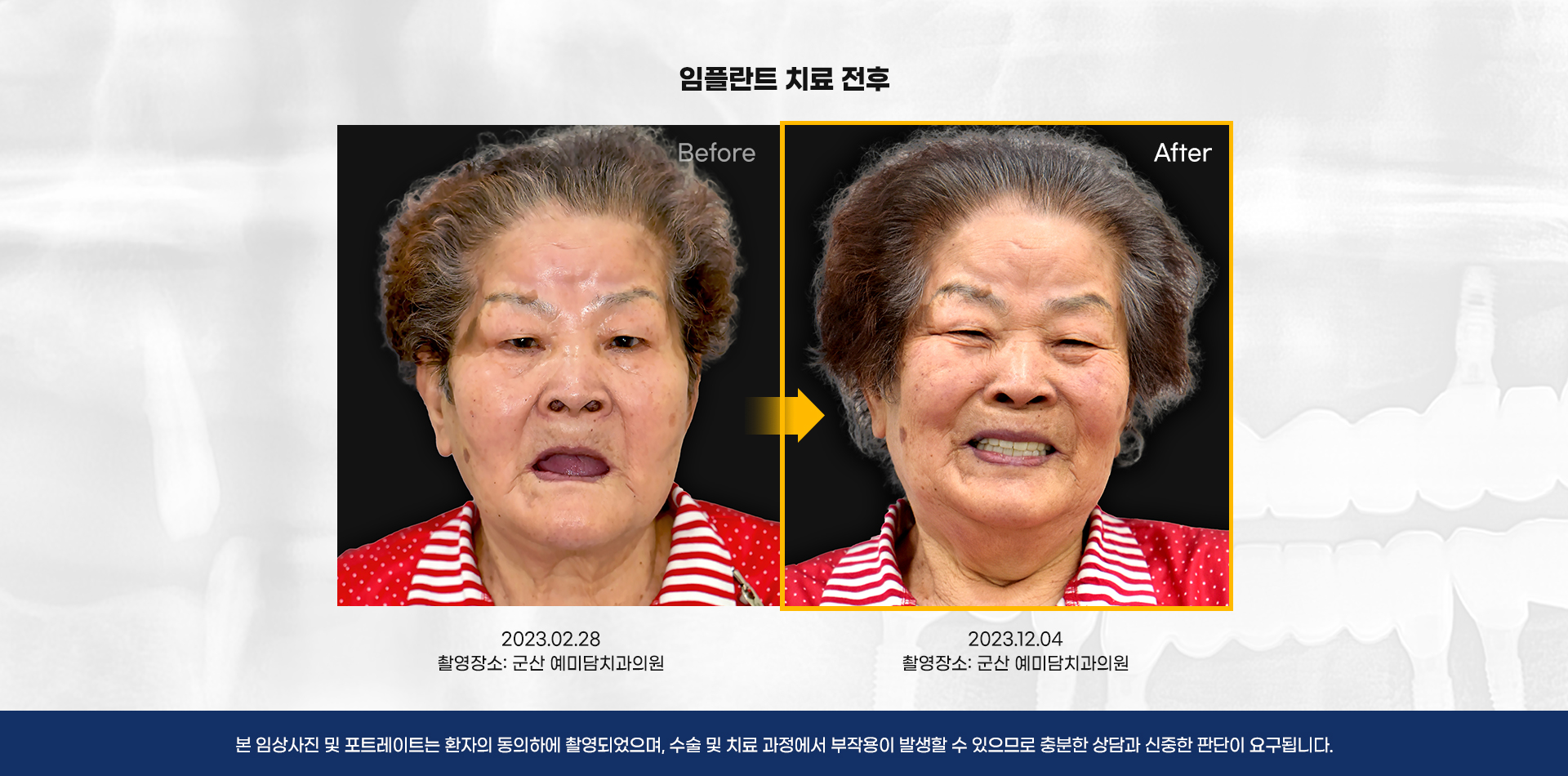 ���ö�Ʈ ġ������